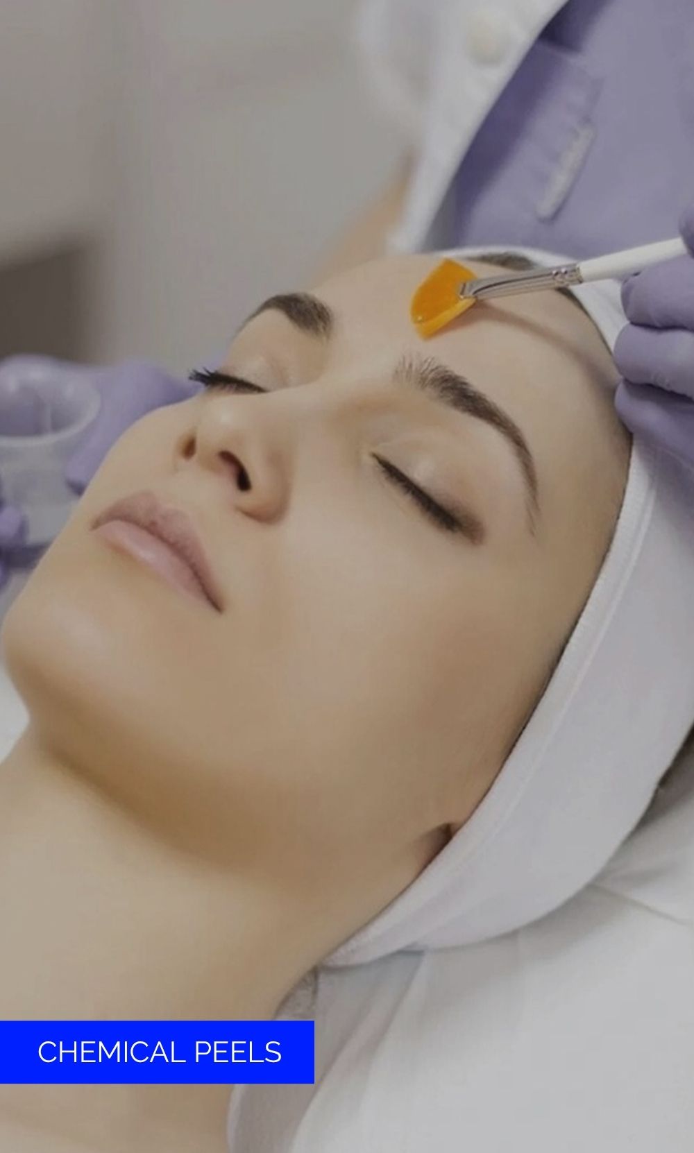 CHEMICAL PEELS